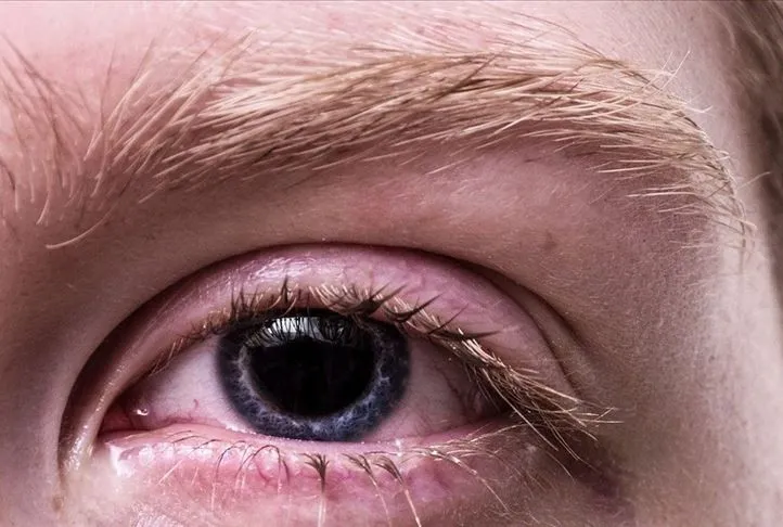 Göz alerjisi mevsimi