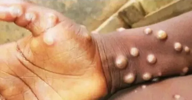 Son dakika: DSÖ'ye göre dünya genelinde maymun çiçeğinden 3 kişi öldü