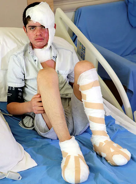 karsta-buzagi-otlatirken-kopan-yuksek-gerilim-akimina-kapilan-ebubekirin-ayak-tabanlari-patladi-1594805753540.jpg Kars'ta buzağı otlatırken kopan yüksek gerilim akımına kapılan Ebubekir'in ayak tabanları patladı-5