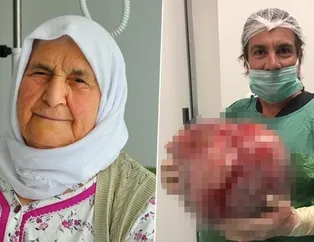 Kilo aldığını sandı, karnından 12 kiloluk kist çıktı