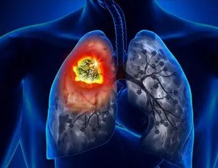 Akciğer kanseri keser nefes