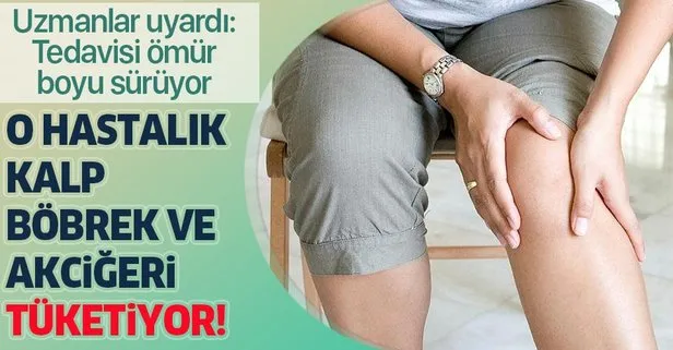 Romatizma Tedavisi Omurluk Romatizma Kalp Bobrek Ve Akcigerleri Tuketiyor Takvim