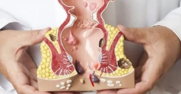 Uzmanlar, basur olanlar için beslenme tavsiyesi verdi!