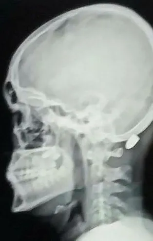 1 cm ile felç olmaktan kurtulan 18 yaşındaki genç: İlk başta çekiçle vurdular sandım