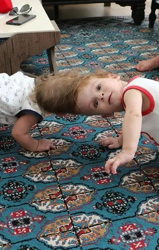 Başkan Erdoğan güzel haberi duyurmuştu! Antalyalı siyam ikizleri Derman ve Yiğit Evrensel'den yeni fotoğraf