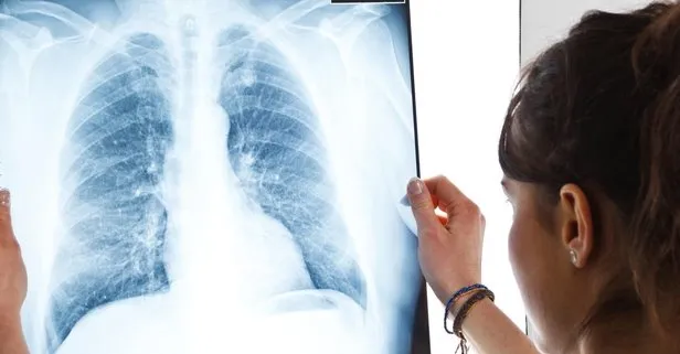 Akciğer kanseri sinsi sinsi ilerliyor!