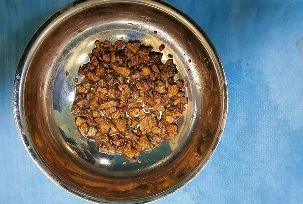 idrarda-kan-bobrekte-tas-iste-bu-hastaliktan-korunmanin-yollari-1671410175609.jpeg İdrarda kan böbrekte taş! İşte bu hastalıktan korunmanın yolları...-4