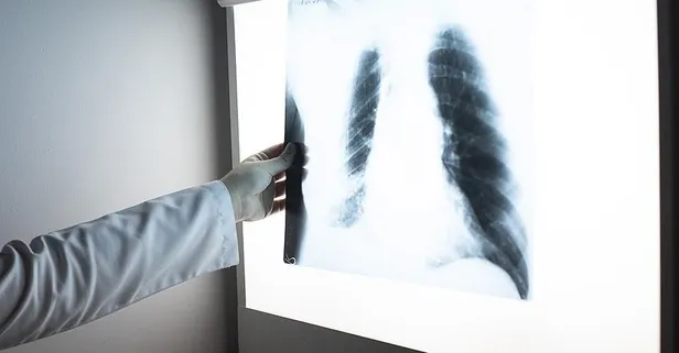 Tüberküloz vakalarında 29 yılın rekoru: 8,2 milyon kişi hastalandı