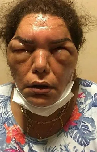 Güzellik merkezinde botoks yaptırdı, yoğun bakımlık oldu! İşlemi yapan doktor değil kuaför çıktı...