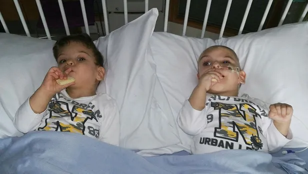 Başkan Erdoğan'ın talimatıyla Londra'ya yollanan siyam ikizleri ameliyatla ayrıldı-1