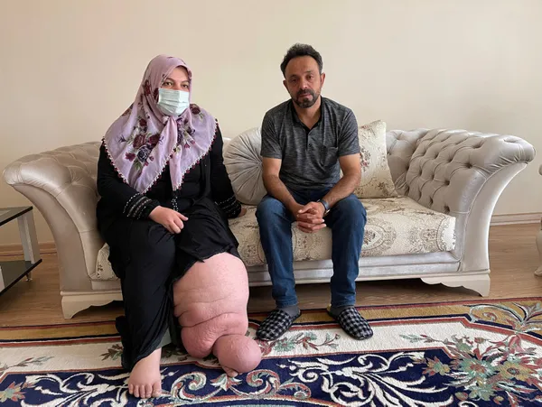 bundan-21-yil-once-fil-hastaligina-yakalanan-2-cocuk-annesi-ayse-bolatin-tek-istegi-corap-ve-ayakkabi-giyip-cocuklariyla-disariya-cikmak-istiyor-1628412573244.jpg Bundan 21 yıl önce fil hastalığına yakalanan 2 çocuk annesi Ayşe Bolat'ın tek isteği çorap ve ayakkabı giyip çocuklarıyla dışarıya çıkmak istiyor-6