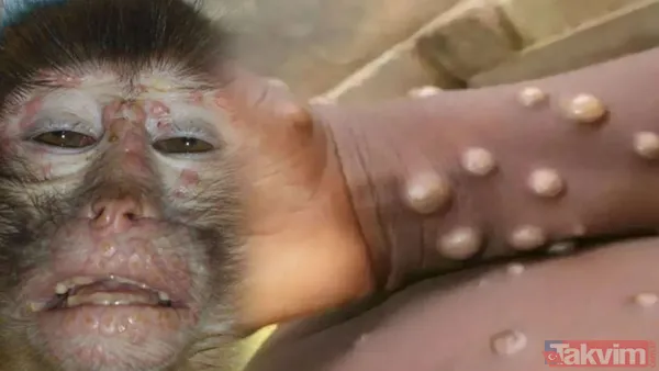 Maymun çiçeği nedir? Belirtileri neler? Çiçek aşısı Maymun çiçeğinden korur mu? Türkiye’de vaka görüldü mü? Sağlık Bakanlığı açıkladı - 11