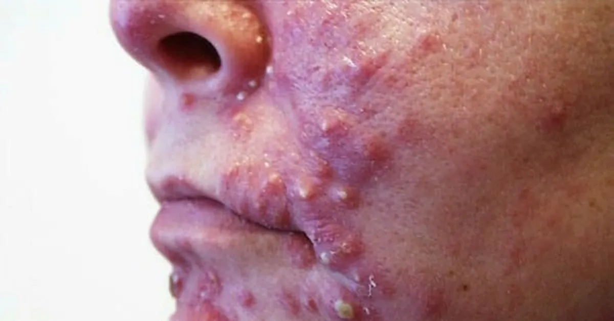 iltihapli sivilce nasil gecer iste