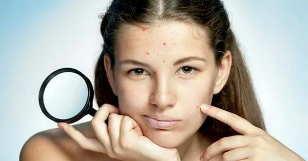 Rüyada yüzünde sivilce görmek ne anlama gelir? Rüyada sivilce sıkmak