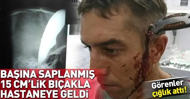 Başına saplanmış 15 cm'lik bıçakla kurtuldu!