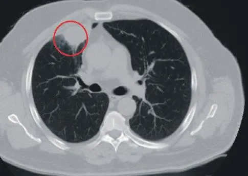 Dünya tıp literatüründe bir ilk yaşandı! Sütçü İmam Üniversite Hastanesi'nde kanser sanılan hasta, Covid'li çıktı-1