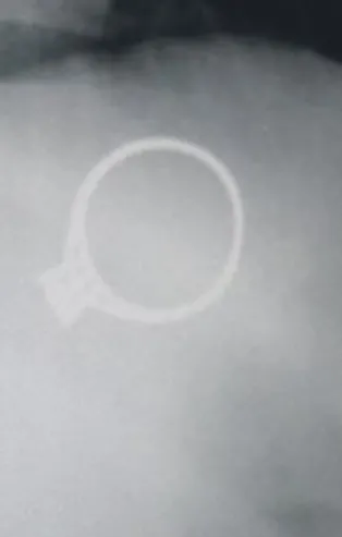 Sivas'ta 1,5 yaşındaki bebek annesinin tek taş yüzüğünü yuttu