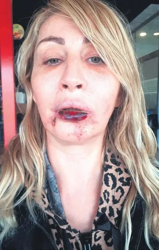 Estetik sonrası dudağı çürüyen Songül Uzunoğlu: Çok mağdur var