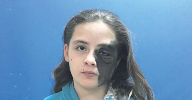 Yüzünün yarısını kaplayan 'ben'den 11 yıl sonra kurtulacak