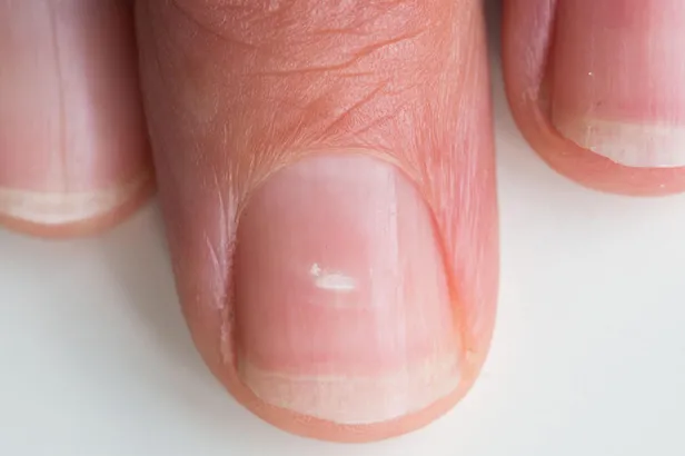 tirnaklardaki-beyaz-cizgilerin-nedeni-meger-buymus-herkes-farkli-biliyordu-meger-1697460205103.jpg Tırnaklardaki beyaz çizgilerin nedeni meğer buymuş! Herkes farklı biliyordu: Duyunca çok şaşıracaksınız!-6