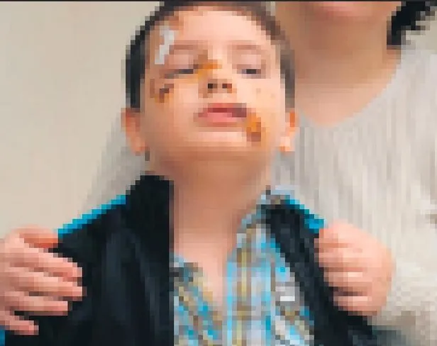 Sokak köpekleri saldırısının adresi bu kez Manisa! 8 yaşındaki çocuğa 60 dikiş atıldı-2