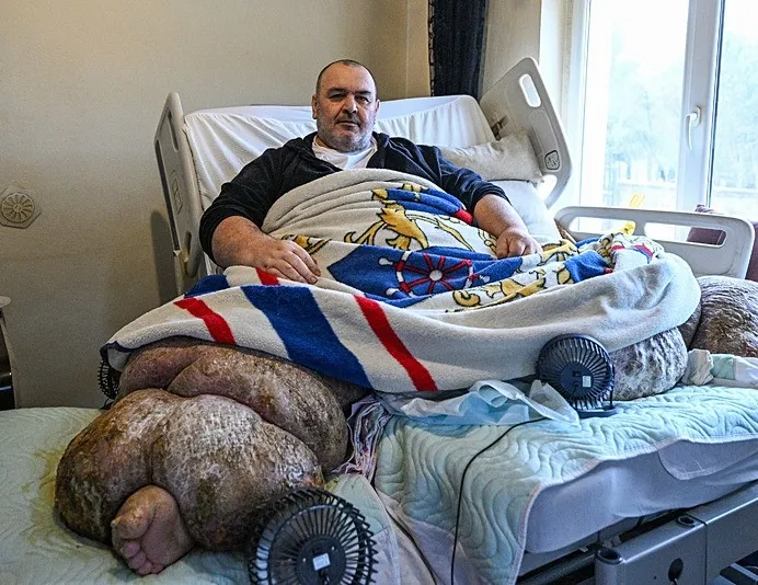 300 kiloya ulaşan fil hastası Engin Akbadal özel ekiple evden çıkarıldı Ankara’ya sevk edildi