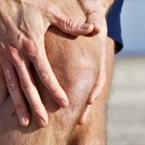 Romatizma böbreğe zarar