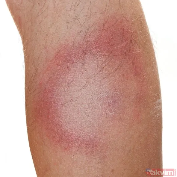Lyme hastalığı nedir? AIDS�ten bile tehlikeli olan lyme hastalığı
