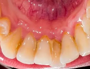 Diş taşı nasıl geçer? İşte diş taşlarını temizleyen mucizevi yöntem!
