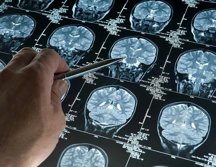 Alzheimer hapı yuttu