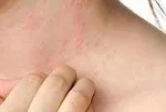 İlaç alerjileri ölüme kadar gidebilir!