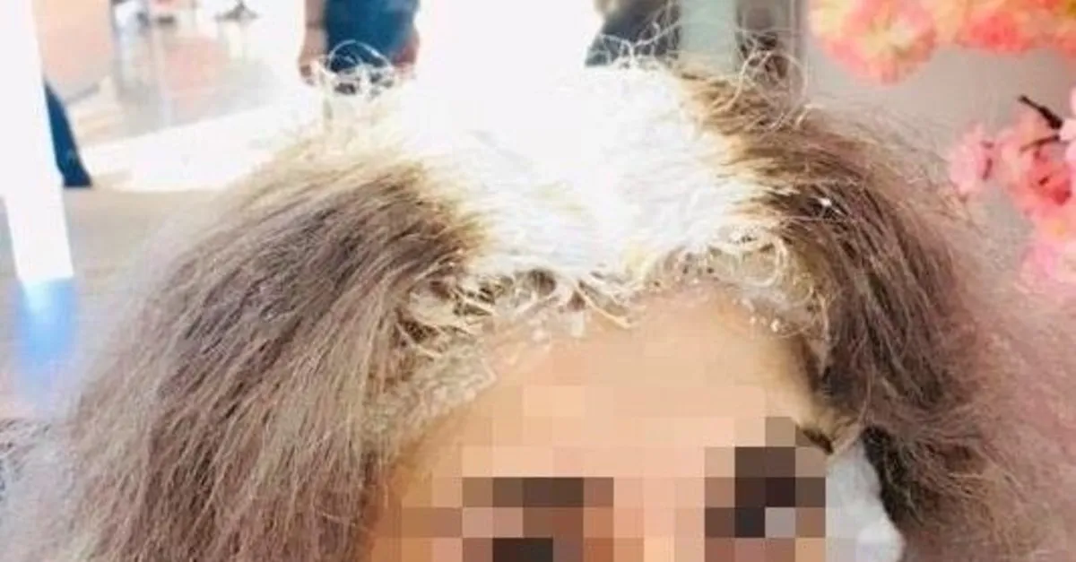 Saclarini Boyatmak Icin Kuafore Gitti Kafatasi Derisi Yandi Takvim