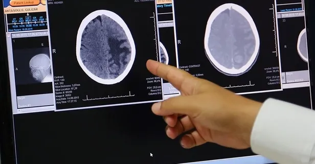 Beyin tümörüne dikkat! Çocuklukta baş bölgesine alınan radyasyon risk faktörü