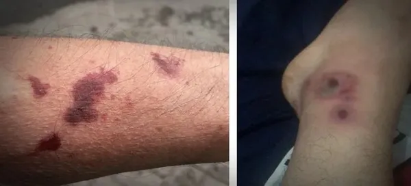 O ilde büyük panik! Isırdığı yeri çürütüyor! 'Asya Kaplanı' denilen...-3