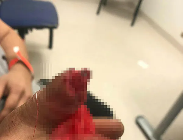 Kopan parmağını sırt çantasında Türkiye’ye getirdi!