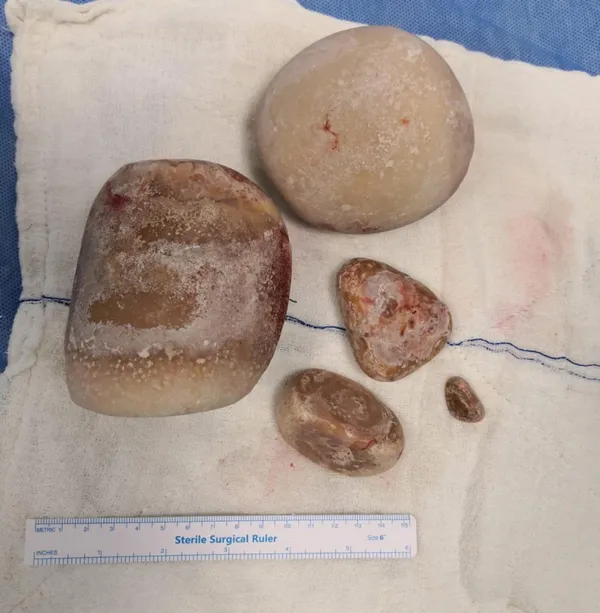 koronavirus-salgini-doneminde-agrilara-ve-idrar-kacirmaya-dayanamadi-hastaneye-gitti-mesanesinden-25-kg-tas-cikarildi-1609152423252.jpg Koronavirüs salgını döneminde ağrılara ve idrar kaçırmaya dayanamadı hastaneye gitti mesanesinden 2,5 kg taş çıkarıldı-5