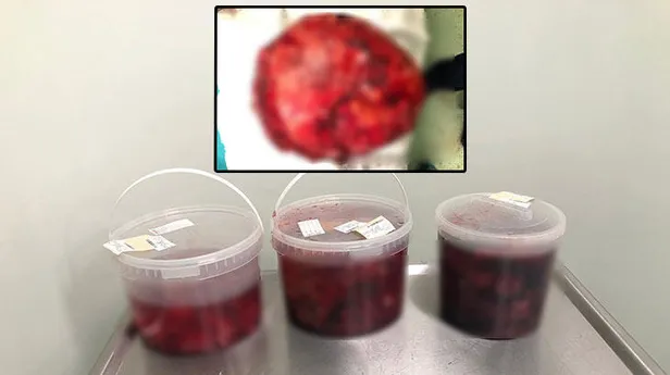 kilo-aldigini-sayoyordu-ama-karnindan-futbol-topu-buyuklugunde-ur-cikti-1593501762313.jpg Kilo aldığını sayoyordu ama karnından futbol topu büyüklüğünde ur çıktı-1