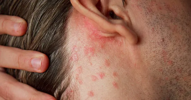 Cildi resmen resetliyor! Kına ile egzama, sedef, akne, leke tedavisi! Meğer ilaçtan daha etkiliymiş