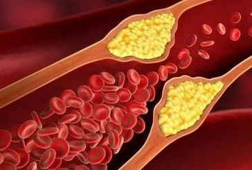 6 adımda kolesterolü düşürün