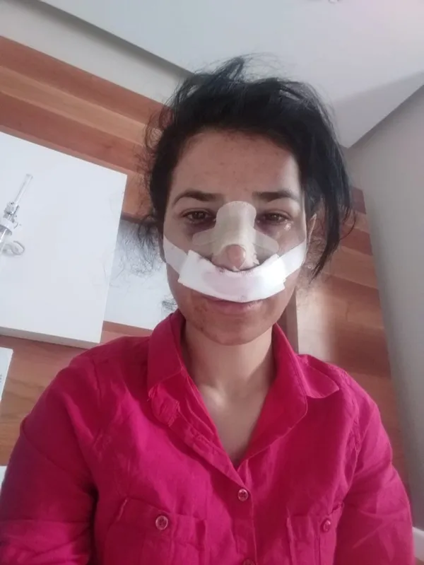 burun-estetigi-yaptiran-kadinin-hem-burnu-yamuk-oldu-hem-de-vucudunda-stresten-dolayi-yaralar-cikti-1607500946239.jpg