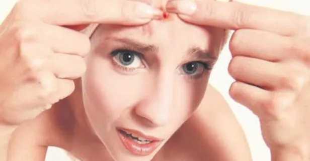 Uzmanı açıkladı: Aknelerden kurtulmak için hangi tedavi uygulanmalı!