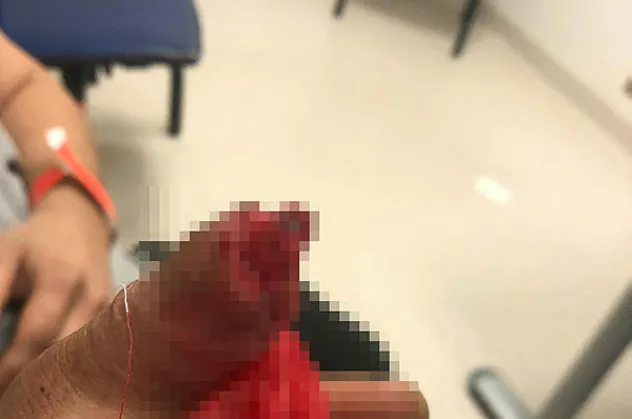 Malta'da kopan parmağını sırt çantasında Türkiye'ye getirdi! Bu ameliyatın dünyada örneği yok!