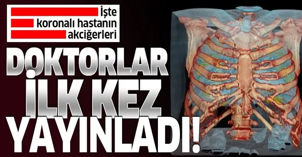 Koronalı akciğerin 3D görüntüsü