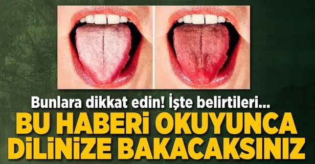 dildeki beyazlik hastalik habercisi