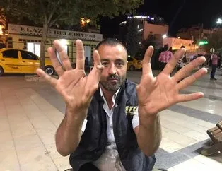 11 parmaklı adam görenleri hayrete düşürüyor