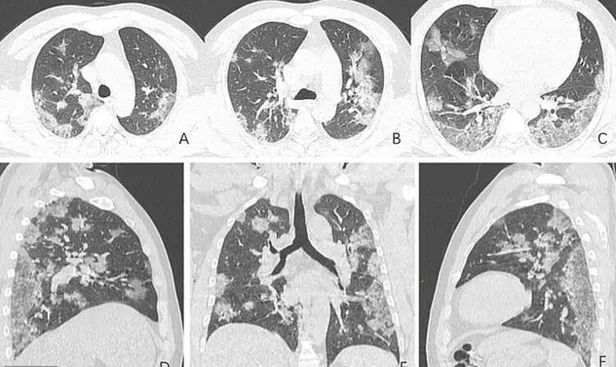 Koronavirüs ciğerleri bu hale getiriyor! Röntgen filmleri dehşete düşürdü!-4