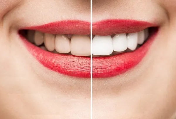 Bembeyaz dişler için çilekle dişlerinizi fırçalayın! Nasıl mı?-2