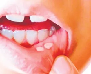 Ülser ağzınızda!