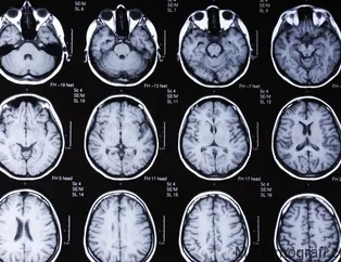 Çiğ et yedi tüm beynini tenyalar sardı