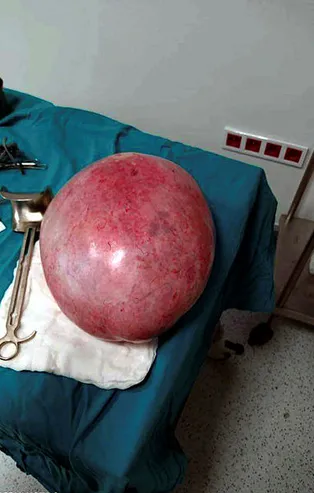 Ağrı şikayeti ile hastaneye gitti! 18 yaşındaki kızın karnından 9 kilo 800 gram kitle çıkarıldı